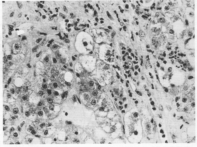 figura 1 - Esteatohepatitis no alcohlica. Infiltrado inflamatorio a predominio de PMN centrolobulillar.